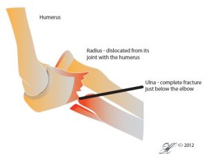 Fractured Elbow Orthoanswer