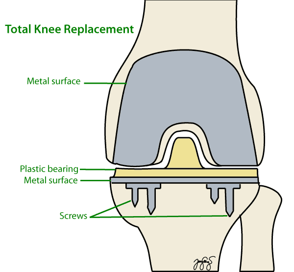 Total Knee Replacement Orthoanswer