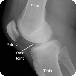 Patellar Tendinitis - Orthoanswer