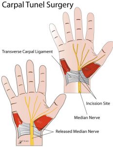 Carpal Tunnel Syndrome - Orthoanswer